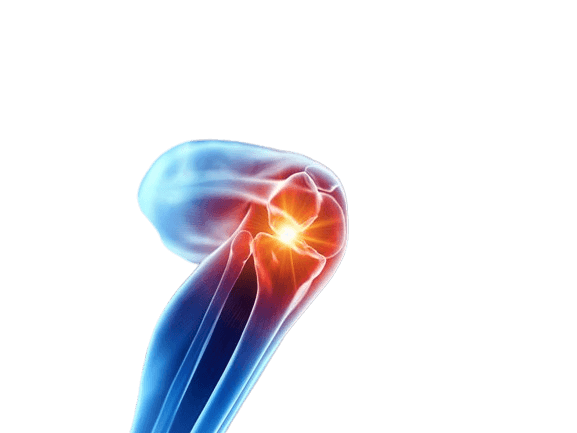 Illustration of osteoarthritis affecting the knee joint