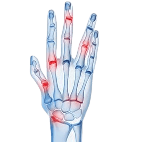 Psoriatic arthritis