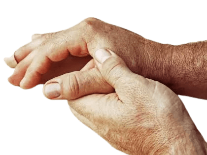 Illustration of connective tissue disease affecting joints and soft tissues