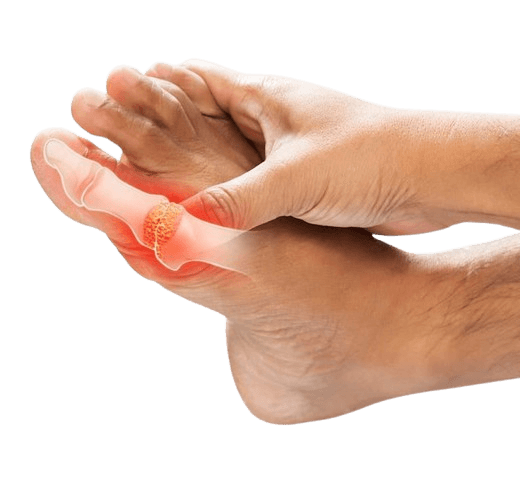 Illustration of gout affecting the foot and joint