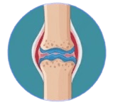 Stage 1 pre-clinical rheumatoid arthritis joint illustration