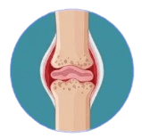 Stage 2 early rheumatoid arthritis joint illustration