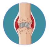 Stage 3 late rheumatoid arthritis joint illustration