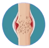 Stage 4 end-stage rheumatoid arthritis joint illustration