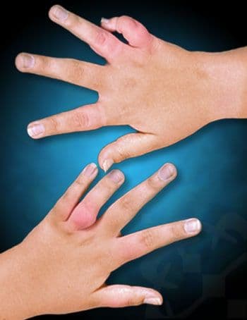 Juvenile arthritis illustration