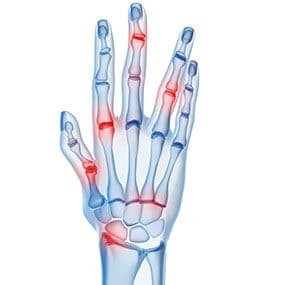 Psoriatic arthritis hand illustration