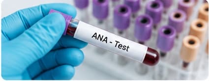 Laboratory ANA blood test sample